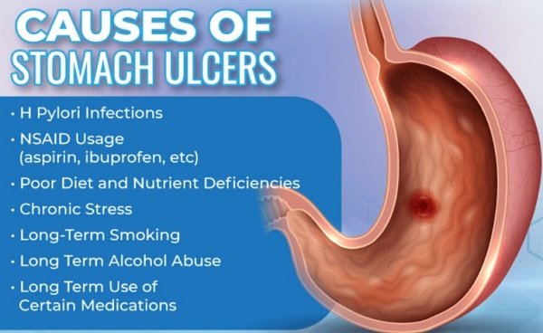 Stomach Ulcer Prevention: Top Causes and Effective Strategies for a Healthy Digestive System