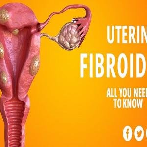 Fibroids Treatment Medicine Without Surgery in Accra, Ghana