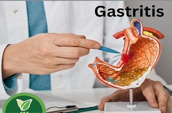 Gastritis Causes| Symptoms | Treatment Medicine at Home