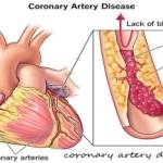 Coronary Artery Disease Treatment Medicine in Accra, Ghana