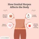 Genital Herpes Treatment Medicine in Accra, Ghana