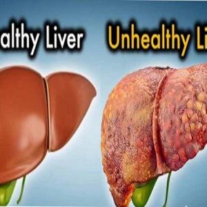 Liver Detox Supplements: Natural Ways to Support Liver Repair and Function in Accra, Ghana