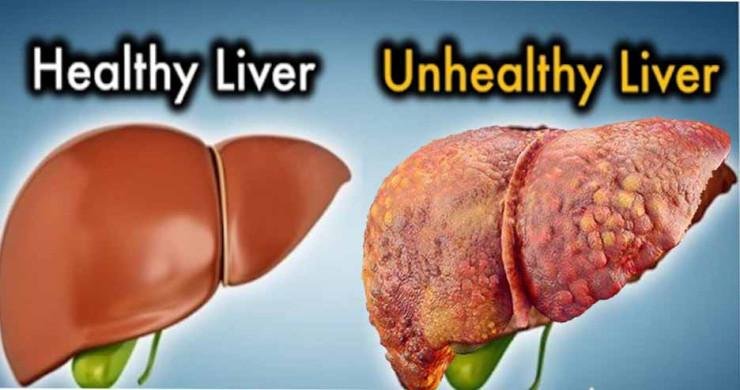 Liver Disease and Infections: Causes | Symptoms | Treatment