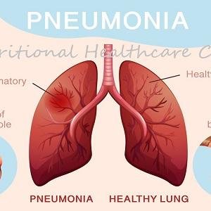 Pneumonia Treatment Medicine, Ghana