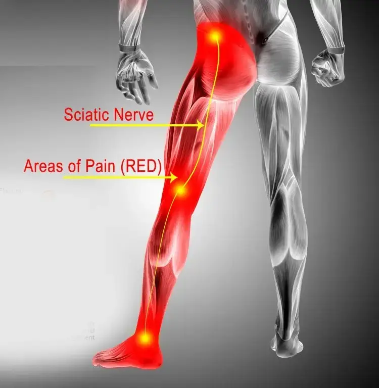 Sciatic Nerve Pain: Causes | Exercises | Immediate Relief | Treatment Medicine